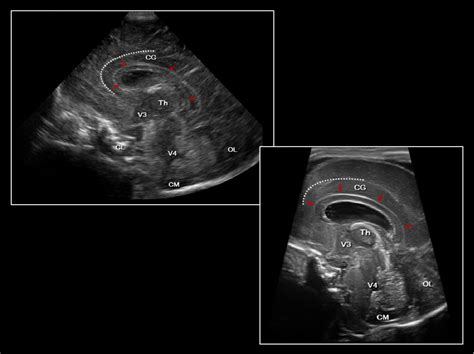 ecografia transfontanelara|The ABCs of transfontanellar ultrasound and more